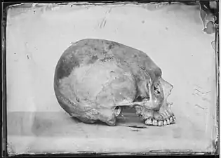 Crâne toulousain déformé, Eugène Trutat - Muséum de Toulouse.