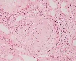 Description de l'image Crescentic glomerulonephritis HE stain.JPEG.