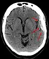 Un hématome sous-dural vu au scanner crânien.