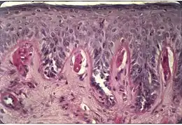 Description de l'image Cutaneous histological features of EPP.jpg.