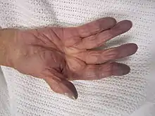 Une main d'une personne blanche est posée sur un drap, paume visible. La main et le poignet ont une coloration rosée normale tandis que les doigts ont une teinte bleu sombre.