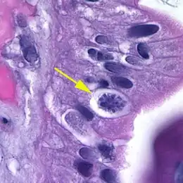 Description de l'image Cystoisospora belli oocyst in epithelial cell (hematoxylin and eosin) 2.jpg.