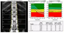 Description de l'image DXA Lumbar vertebral column Osteopenia es.png.