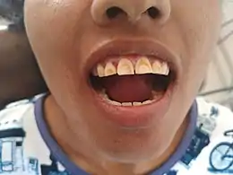 Description de l'image Dental Flurosis (teeth with brown stains).jpg.