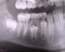 On voit à la fois des dents temporaires et des dents définitives.