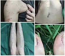  quatre images d'une même patiente, épaule gauche, ventre, faces antérieures des jambes, hallux présentant un semis de petites lésions d'excoriation