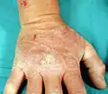 Dermatite herpétiforme – Fig. 4 : Main avec lésions lichénifiées