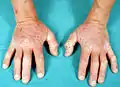Dermatite herpétiforme – Fig. 3 : Mains avec lésions lichénifiées