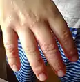 Dermatite herpétiforme – Vésicules et gonflement dans les doigts, aussi commun dans les pieds