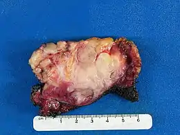 Description de l'image Desmoid-type fibromatosis.gross pathology.jpg.