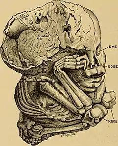 Représentation d'un lithopédion en 1899.