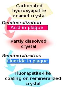 Carbonated hydroxyapatite enamel crystal is demineralized by acid in plaque and becomes partly dissolved crystal. This in turn is remineralized by fluoride in plaque to become fluorapatite-like coating on remineralized crystal