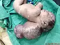 Un nouveau-né avec une grosse encéphalocèle.