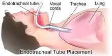 Dessin représentant un être humain en coupe sagittale, une sonde d'intubation allant de la bouche à la trachée.