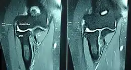 Description de l'image Epicondylitis in MRI.JPG.