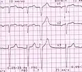 Premature ventricular complexes or Extrasystoles