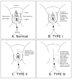 Quatre dessins de vulve montrant les différents types de mutilations