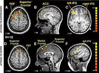 planche sur fond noir représentant deux séries de trois coupes de cerveau humain dans deux plans de l'espace (horizontal et vertical), légendée en lettres jaunes