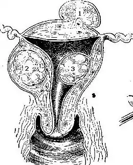 Description de l'image Fibroid.jpg.