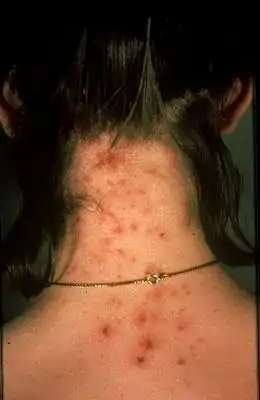 Description de l'image Fig.4.Louse bites.jpg.