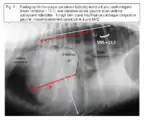 Figure 9 : Radiographie thoracique (incidence latérale) montrant une cardiomégalie (index vertébral = 13,1), une dilatation atriale gauche et un œdème pulmonaire interstitiel : il s’agit bien d’une insuffisance cardiaque congestive gauche, vraisemblablement consécutive à une MVD.