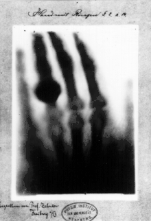 Photographie de la première radiographie de l'histoire prise le 22 décembre 1895 sur la main d'Anna Bertha Röntgen, la femme du découvreur des rayons X.