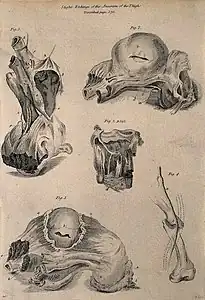 Cinq exemples d'anévrismes de la cuisse, par Daniel Lizars (1810).