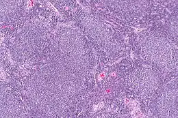 Description de l'image Follicular lymphoma -- low mag.jpg.