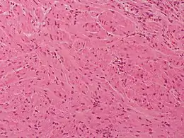 Description de l'image Granular cell tumor Case 174 (5600864519).jpg.