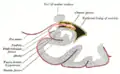 Section coronale de la corne inférieure du ventricule latéral.