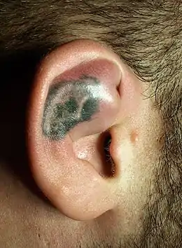 Description de l'image Hematoma ear.jpg.