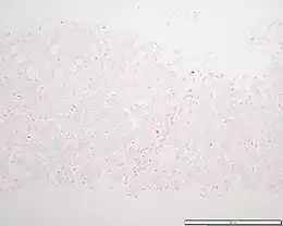 Description de l'image Hemochromatosis liver section.JPG.