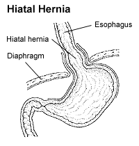 Description de l'image Hiatalhernia.gif.