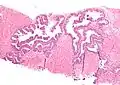 Néoplasie prostatique intraéphithéliale de haut grade (HGPIN)