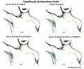 Schémas quantifiant l'hyperhidrose axillaire.