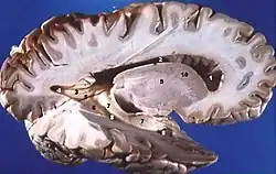 Cerveau humain droit disséqué. Vue latérale.