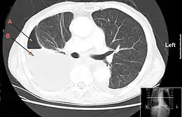 Description de l'image Hydro pneumothorax.jpg.