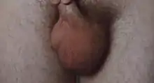 Hydrocèle sur le testicule gauche d'une personne adulte.