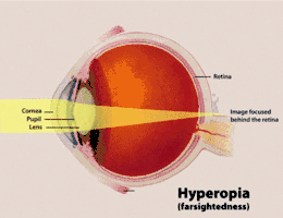 Description de l'image Hyperopia.gif.