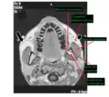 IRM de tête au niveau des dents maxillaires, avec le muscle masséter.