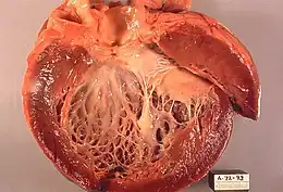 Description de l'image Idiopathic cardiomyopathy, gross pathology 20G0018 lores.jpg.