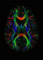 Carte des directions principales de diffusion représentées par un code de couleurs dans une coupe bidimensionnelle de cerveau humain