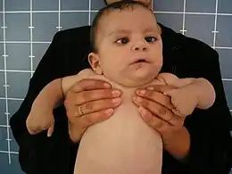 Description de l'image Infant with Möbius syndrome.jpg.