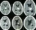 Scanner cérébral objectivant une hémorragie profonde (thalamique gauche) plutôt évocatrice d'une angiopathie hypertensive