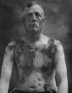 Photographie en noir et blanc représentant un homme à mi-corps, torse nu, vu de face, avec des touffes de poils adhérant au corps.