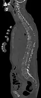 Scanner sagittal reconstruit, représentation dans la fenêtre osseuse. Comme la patiente avait des métastases dans toutes les régions du corps, elle ne pouvait pas lever les bras pour l'examen, ce pourquoi les mains sont présentées.
