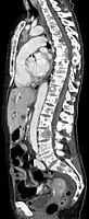 Scanner sagittale, parties molles. Outre les métastases dans la colonne vertébrale, qui envahissent en partie le canal médullaire vers l'arrière, métastases aussi dans le sternum. Plus des métastases dans le foie.