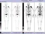 Scintigraphie corps entier avec 99mTc-HDP de la patiente avec une fracture du bras due à une métastase du cancer du sein