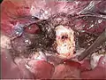 Moignon cervical (blanc) après l'ablation du corps utérin lors de l'hystérectomie supracervicale laparoscopique