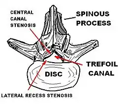 Description de l'image LUMBAR TREFOIL CANAL.JPG.